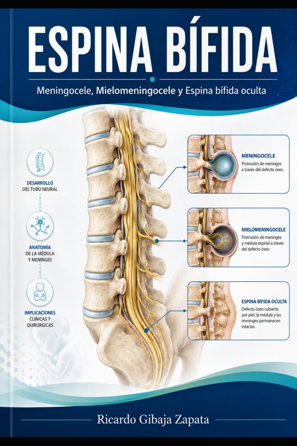 ESPINA BIFIDA Meningocele, Mielomeningocele y Espina bífida Oculta