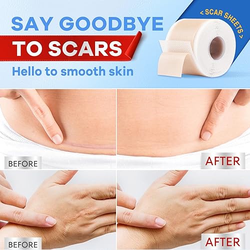 Miniatura 3 de Wifamy Hojas de silicona para cicatrices para mujeres eliminación de cicatrices de grado médico, recuperación de cesárea y cuidado poscirugía (rollo