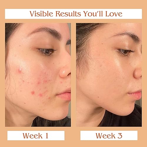 Miniatura 6 de Aceite Kumkumadi Auravedic de Azafrán Puro para una Piel Ultra Radiante | Aceite Ayurvédico para Piel Opaca, Deshidratada y Cansada | Fórmula