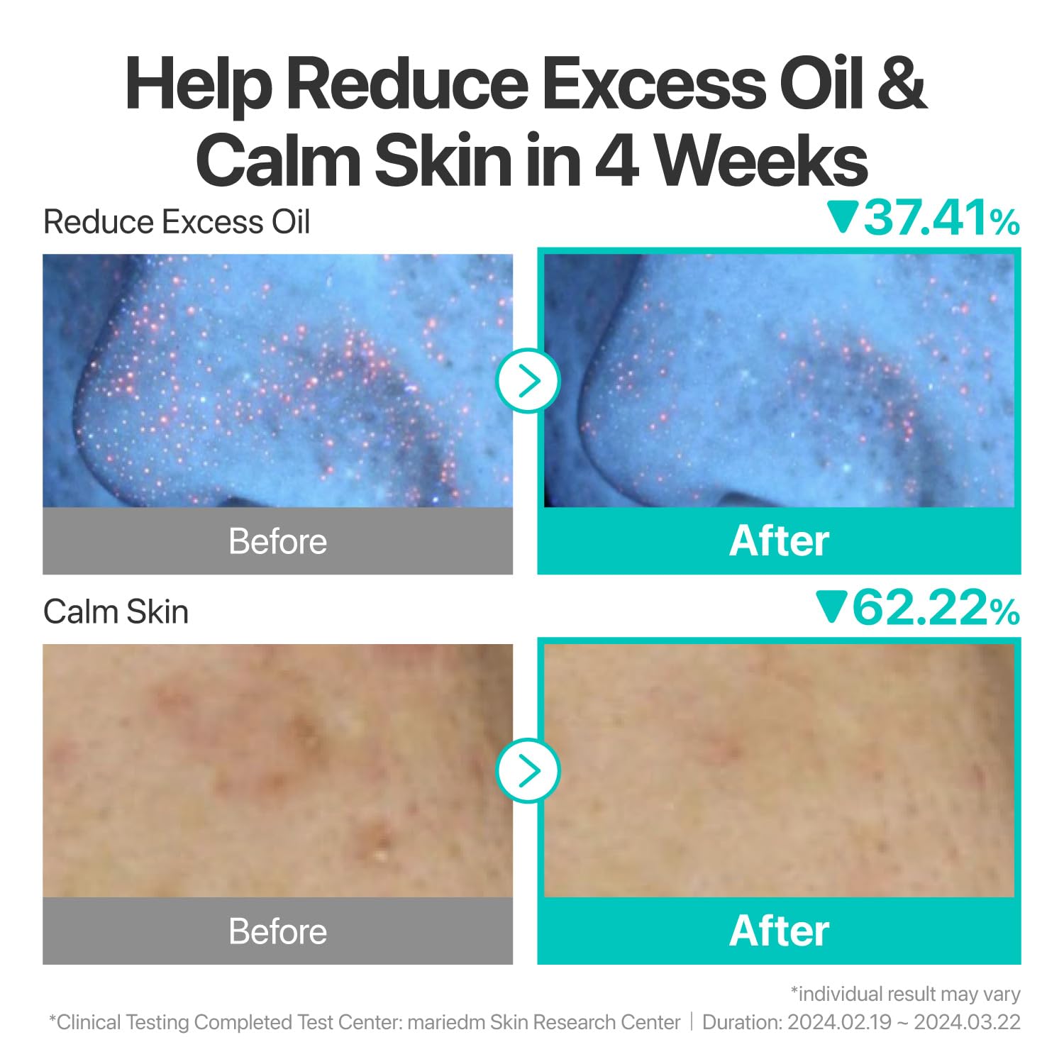 numbuzin No.1 Serum | Pantothenic B5 Active Soothing Serum | Soothing, Hydrating | Pantothenic Acid, Niacinamide | Excess Oil Control, Reduces Breakouts, Acne | Oily, Acne-Prone Skin | 1.69 fl. oz.
