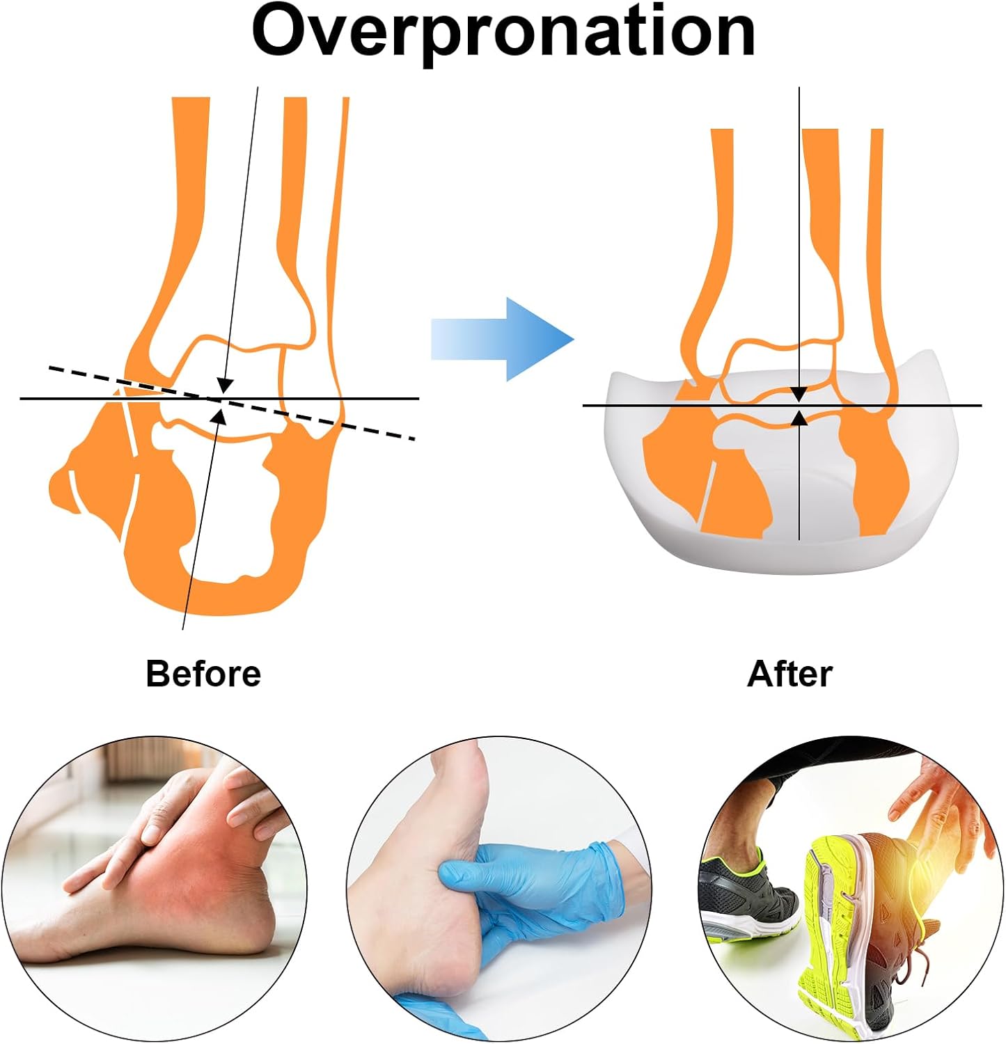 Original 3/4 Arch Support Metatarsal Support Orthotics Over-Pronation Insoles Relieve Plantar Fasciitis, Arch, Heel & Ankle Foot Pain (White, Men 9-12/Women 11-14) - Image 6