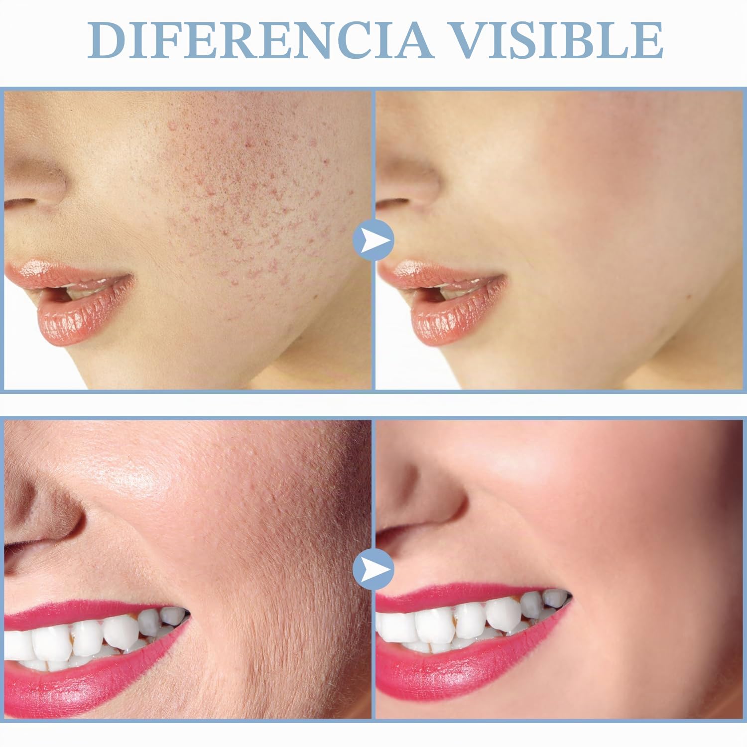 Máquina de Alta Frecuencia Estetica Facial - TUMAKOU Dispositivo Portátil de Alta Frecuencia - Masaje Facial Para El Cuidado de la Cara y la Piel, la Arrugas, Acné