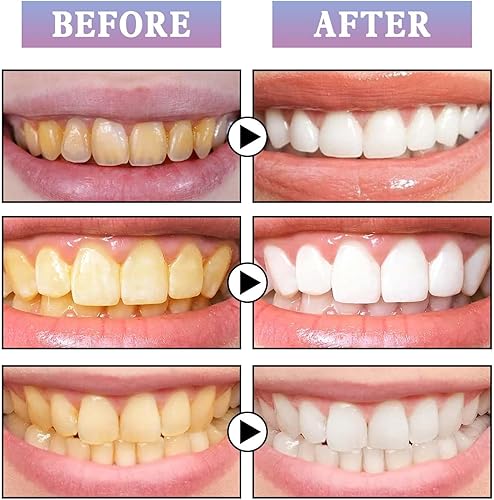 Miniatura 5 de Bolígrafo blanqueador de dientes, pintura dental brillante sonriente, bolígrafo blanqueador de dientes para eliminación de manchas de dientes,