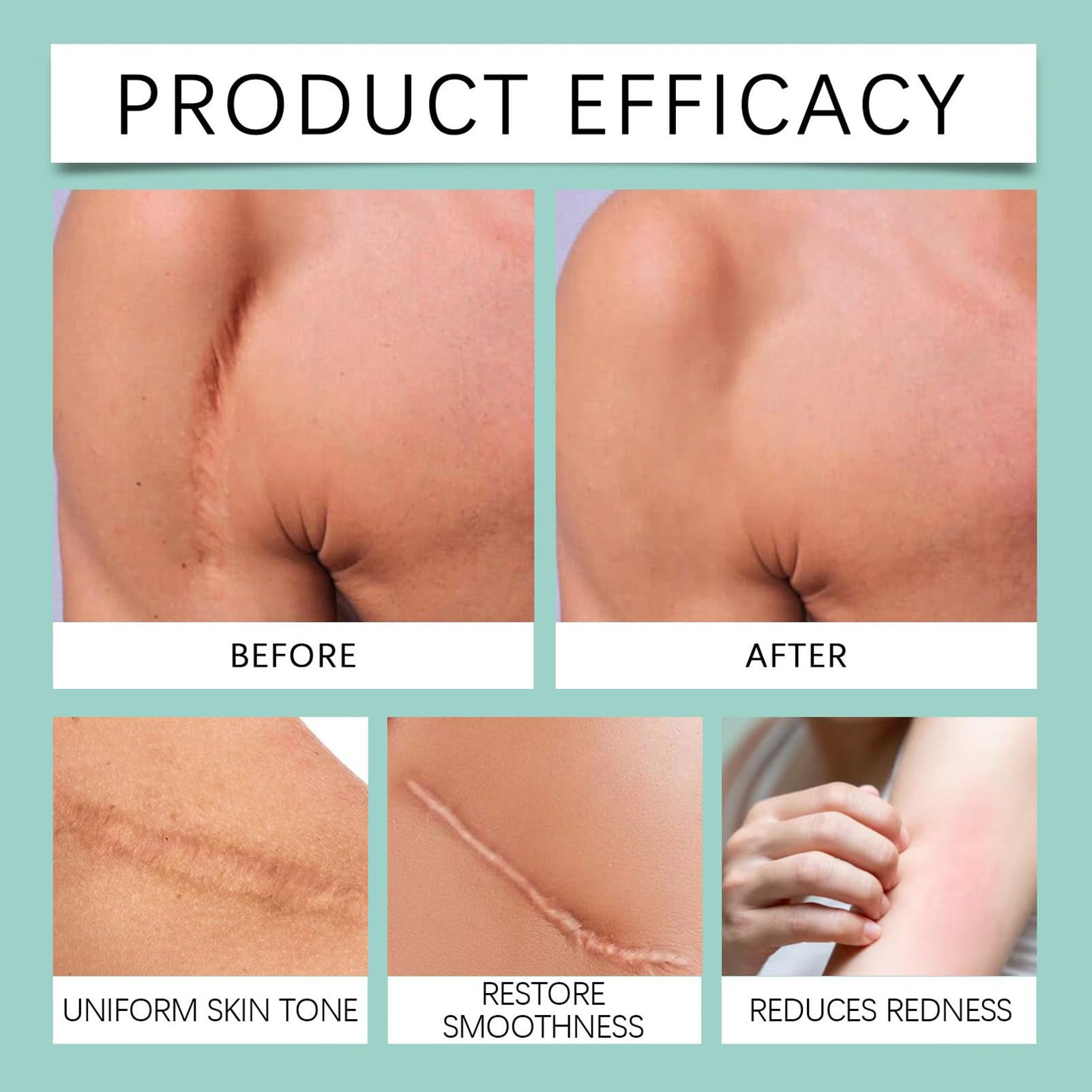 Gel de Silicona para Cicatrices - 50 Gramos Producto Para Desvanecer Marcas De Quemaduras,Nueva Crema Calmante Para Cicatrices,Para Hombres Y Mujeres, Queloides, Amantes De La Belleza, Viajeros, Rutin