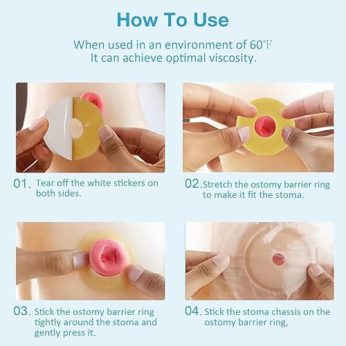 Miniatura 6 de 10 anillos moldeables de barrera para ostomía, anillos elásticos extensores de piel, suministros de bolsa de ostomía hidrocoloide médica de 0.079