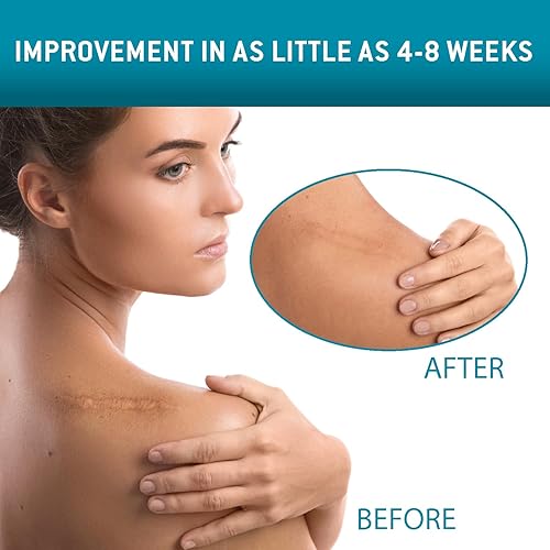 Miniatura 2 de Care Science Cinta de silicona para cicatrices de 1.6 x 120 pulgadas, 1 unidad, cinta para cicatrices quirúrgicas, queloides, eliminación de