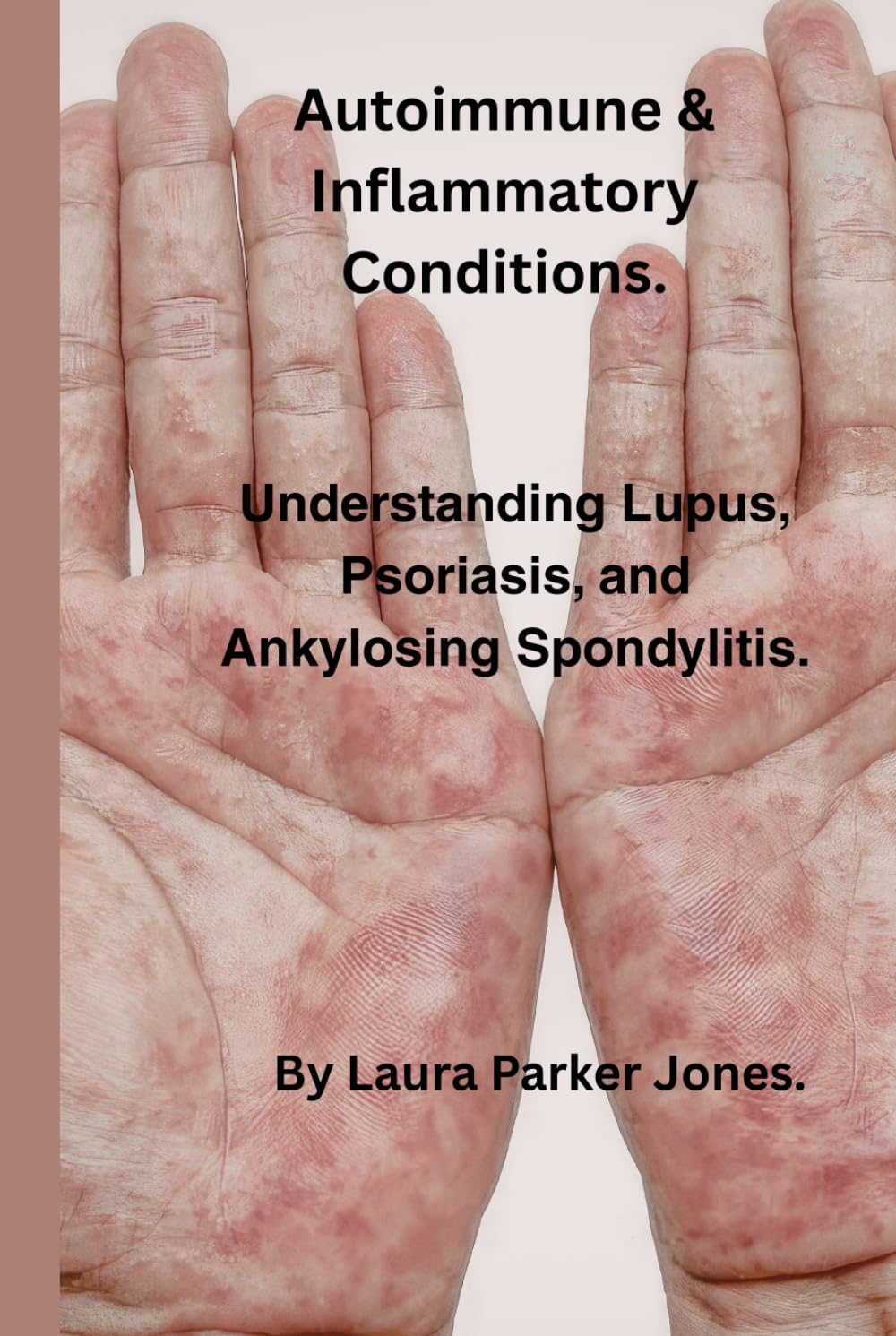 Autoimmune & Inflammatory Conditions.: Understanding Lupus, Psoriasis, & Ankylosing Spondylitis. (Arthritis and You)