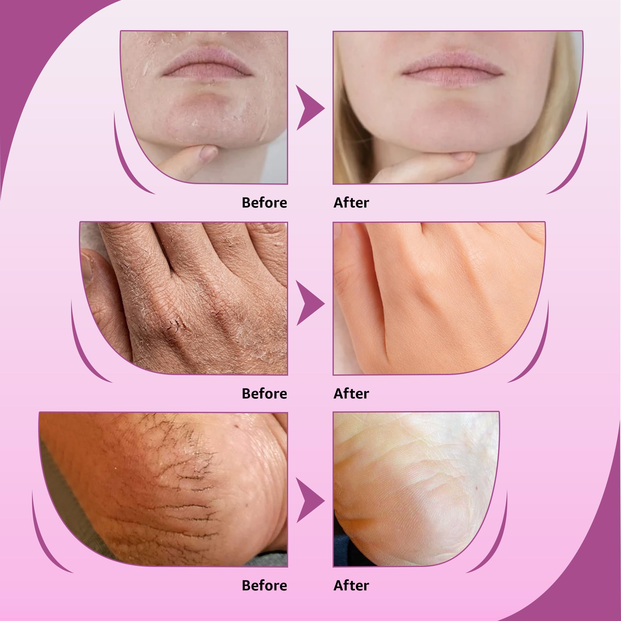 Harnstoffcreme 10% Trockene Haut Feuchtigkeitscreme mit Salicylsäure und Lavendelöl. Triple Action, Urea Healing, Hydrating und Therapeutische Creme für Handfuß und Körper. (Creme, 4oz) (Creme)