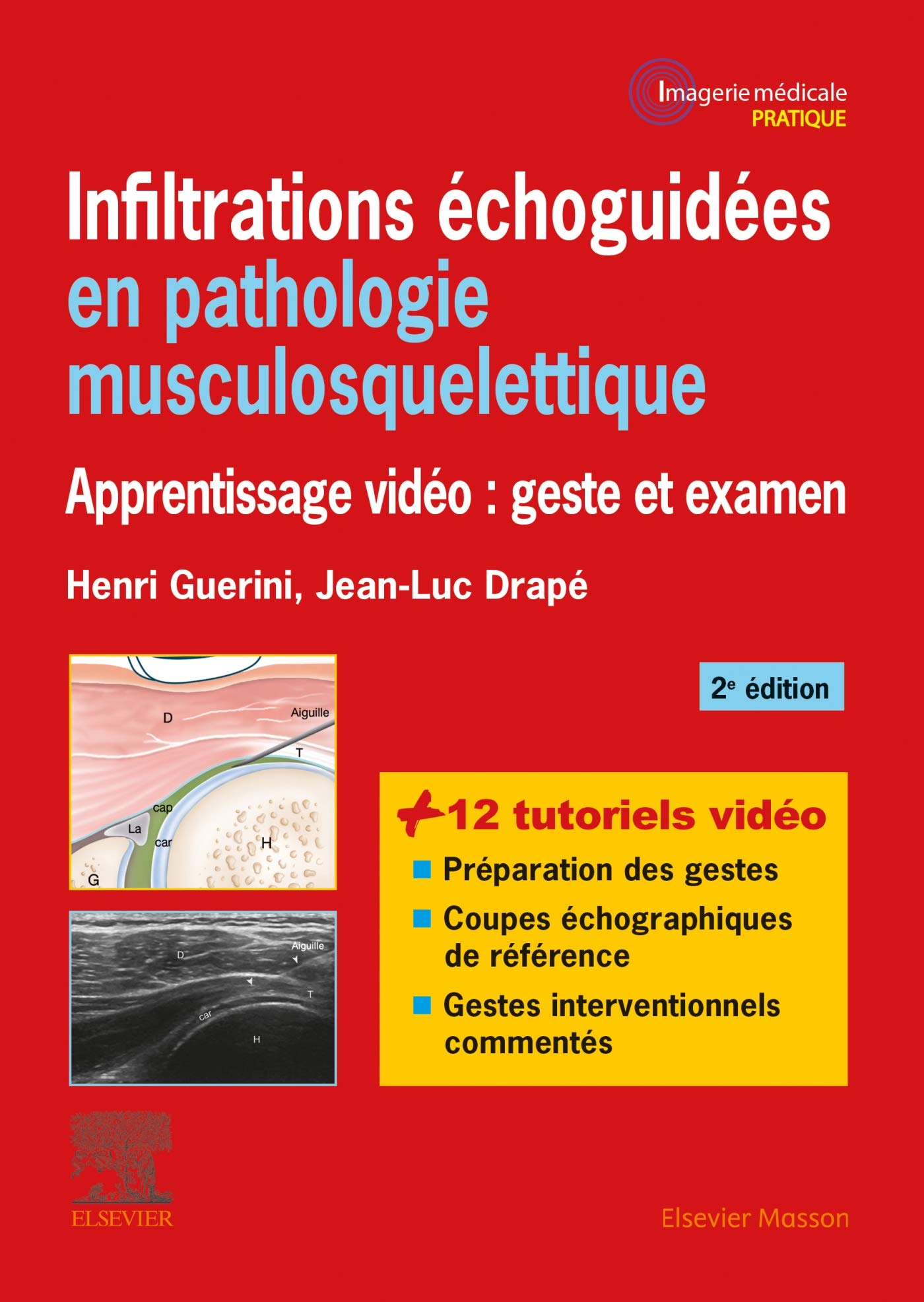 Infiltrations échoguidées en pathologie musculosquelettique: Apprentissage vidéo : geste et examen