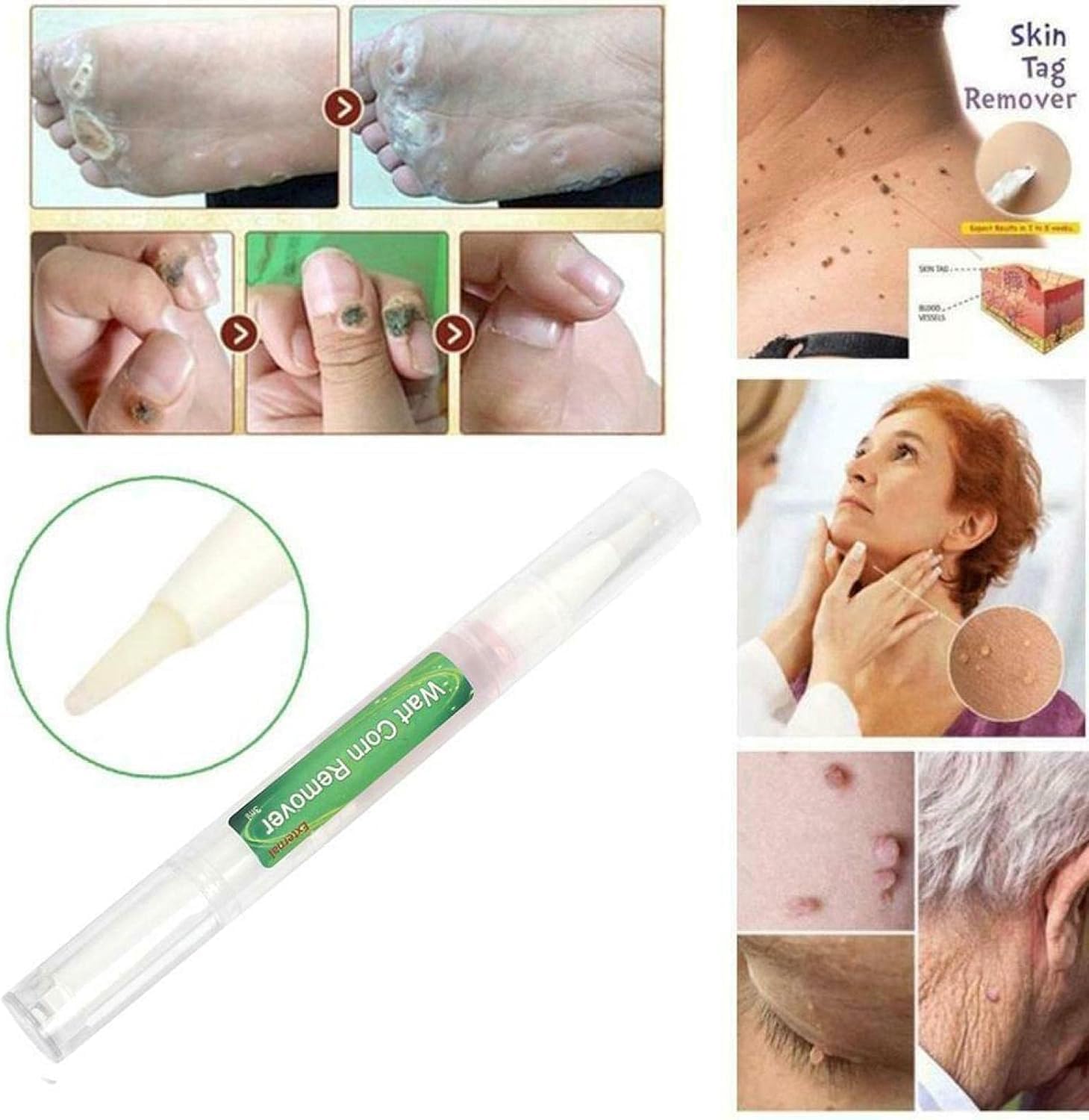 Crème De Traitement Des Verrues - Formule Naturelle - 20g - Taille Voyage - Neuf