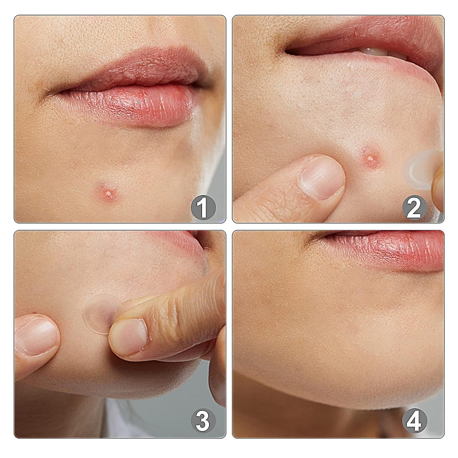 Keli Pimple Patch Hydrocolloid, Pimple Patches, 36 Acne Patches, Acne Plaster, Pimple Acne Patch Plaster in Two Sizes: 24 x 12 mm Diameter and 48 x 0.8 mm Diameter 1