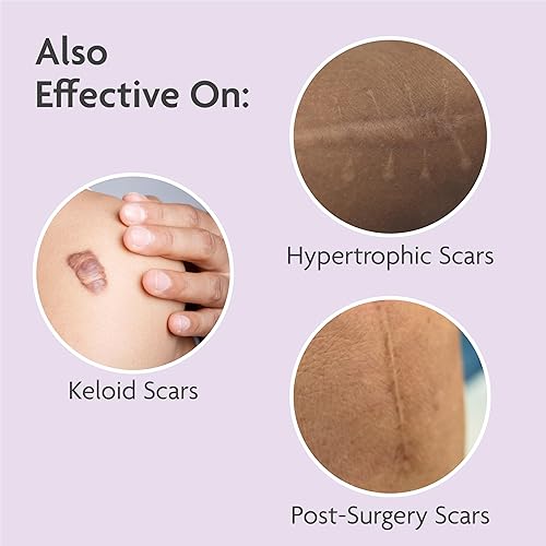 Miniatura 7 de TriLASTIN Hojas de silicona para cicatrices (6 unidades), cinta de silicona para cicatrices, cinta quirúrgica de grado médico, eliminación de golpes