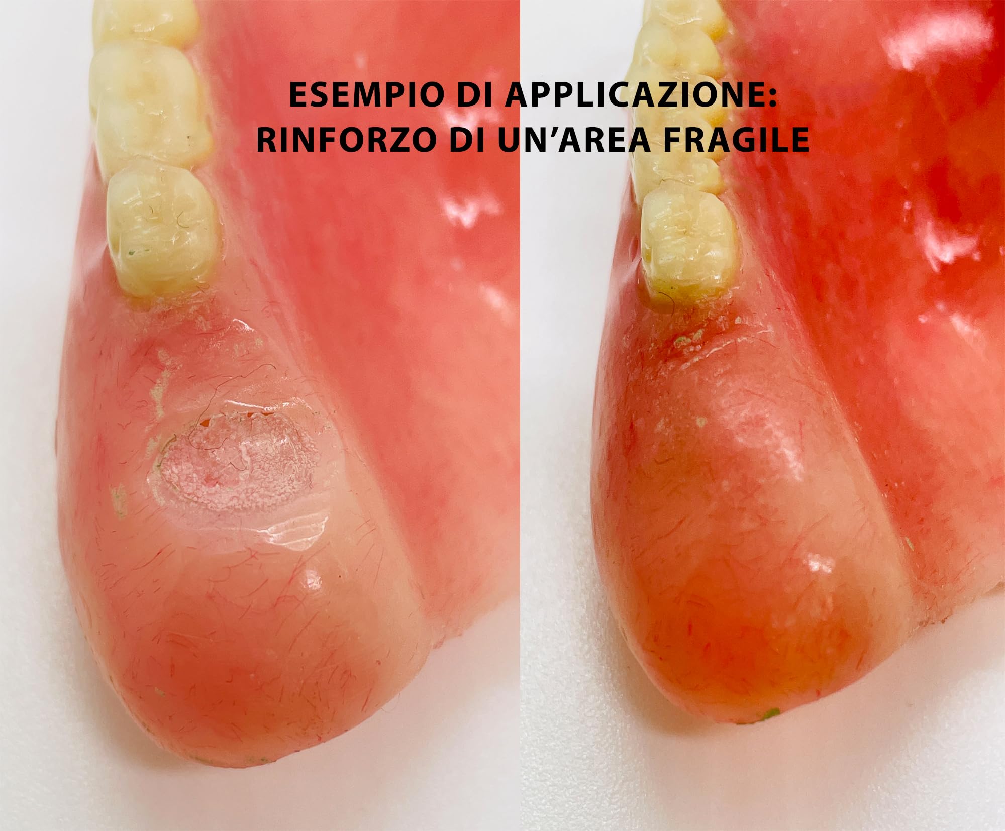 RESINA DENTALE ROSA - MEDIDENT-riparazione protesi - protesi rotte