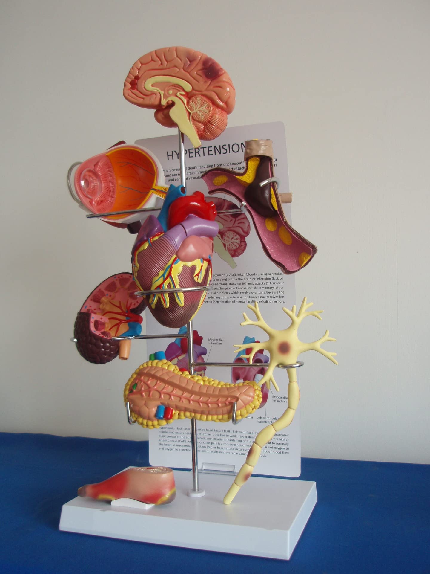 Modèle De Diabète Modèle Visuel Modèle D'hypertension Modèle De Diabète Cerveau, Oeil, Coeur Huit Organes