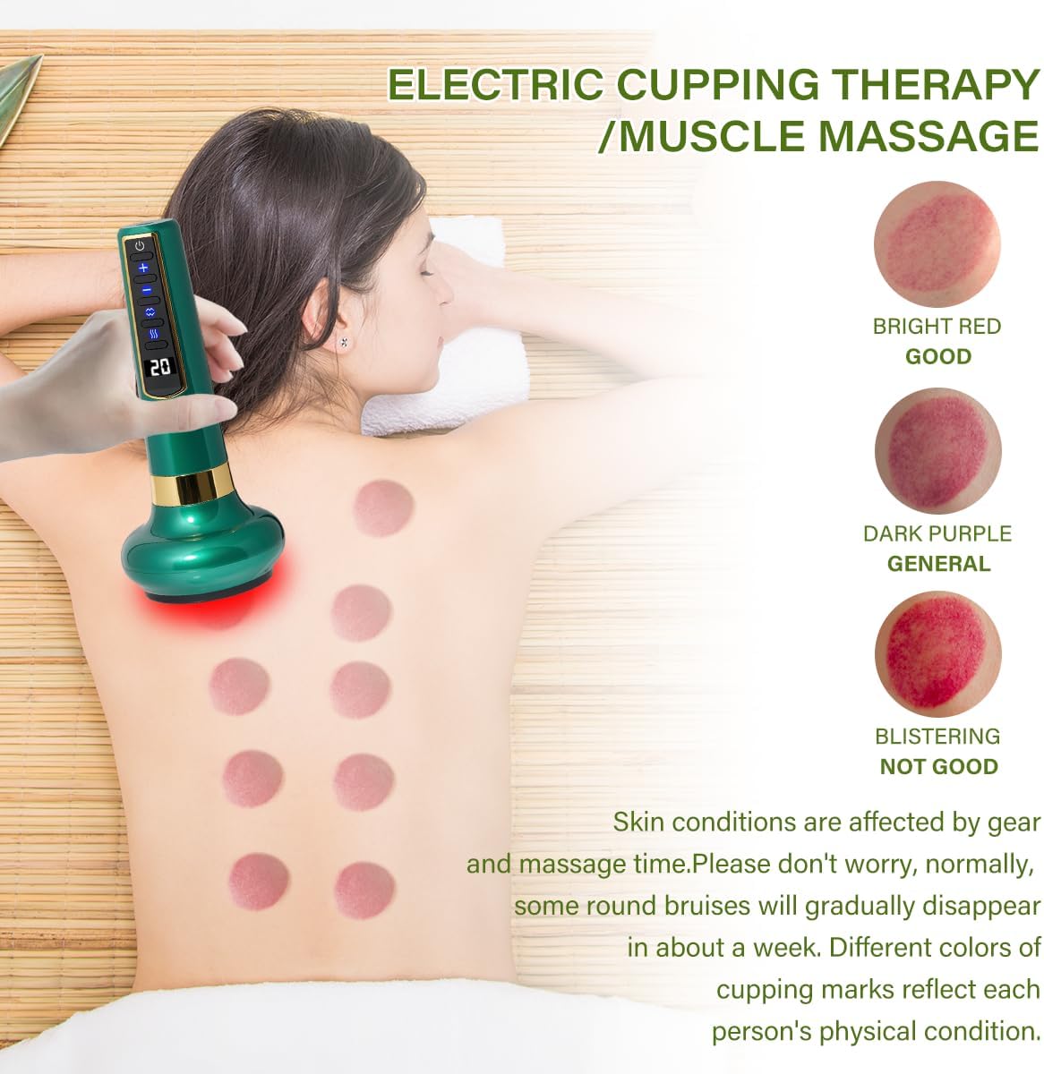 Image explaining cupping marks: Bright Red (Good), Dark Purple (General), Blistering (Not Good), with a person's back showing various marks.