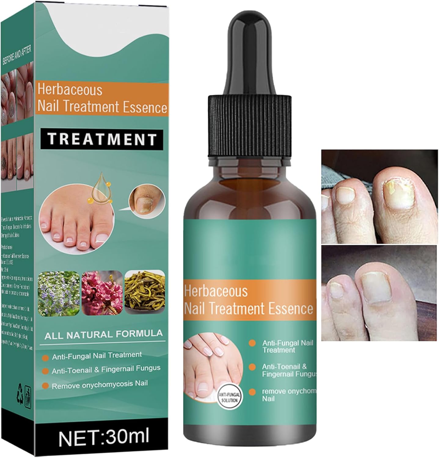 Fungal Nail Treatment, Ingrown Toenail Treatment Nail Care Oils, 30ml