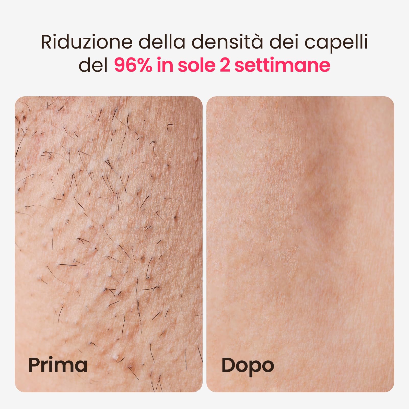 25J Epilatore laser IPL con Triplo Impulso, zaffiro ghiaccio indolore a 3 °C, Epilazione laser definitiva, 999900 impulsi di Luce Pulsata, per Uomo Donna, Ascelle Bikini Corpo,Idea Regalo(viola)