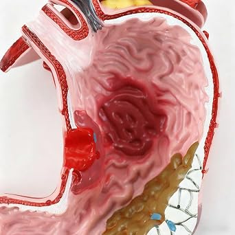 Human Pathological Stomach Model with Base, Detachable Anatomical Model for Gastric Ulcer Chronic Atrophic Gastritis Demonstration, Stomach Lesion Visual Aid Tool
