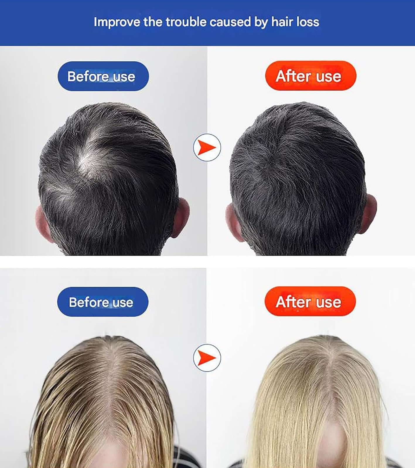 Terapia de crecimiento del cabello con luz roja, tapa infrarroja para el crecimiento del cabello, equipada con 120 luces LED de doble chip, 3 modos, alivia la fatiga