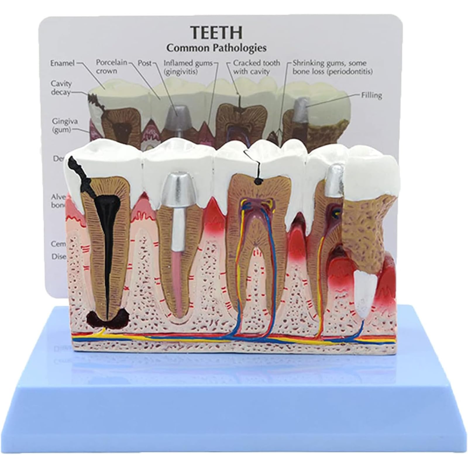 Adtzpc Dental Caries Teeth Model, Human Teeth Anatomy Model, Pathology Demonstration Dental Model with Instructions, for Dentist Office Educational Learning Tool