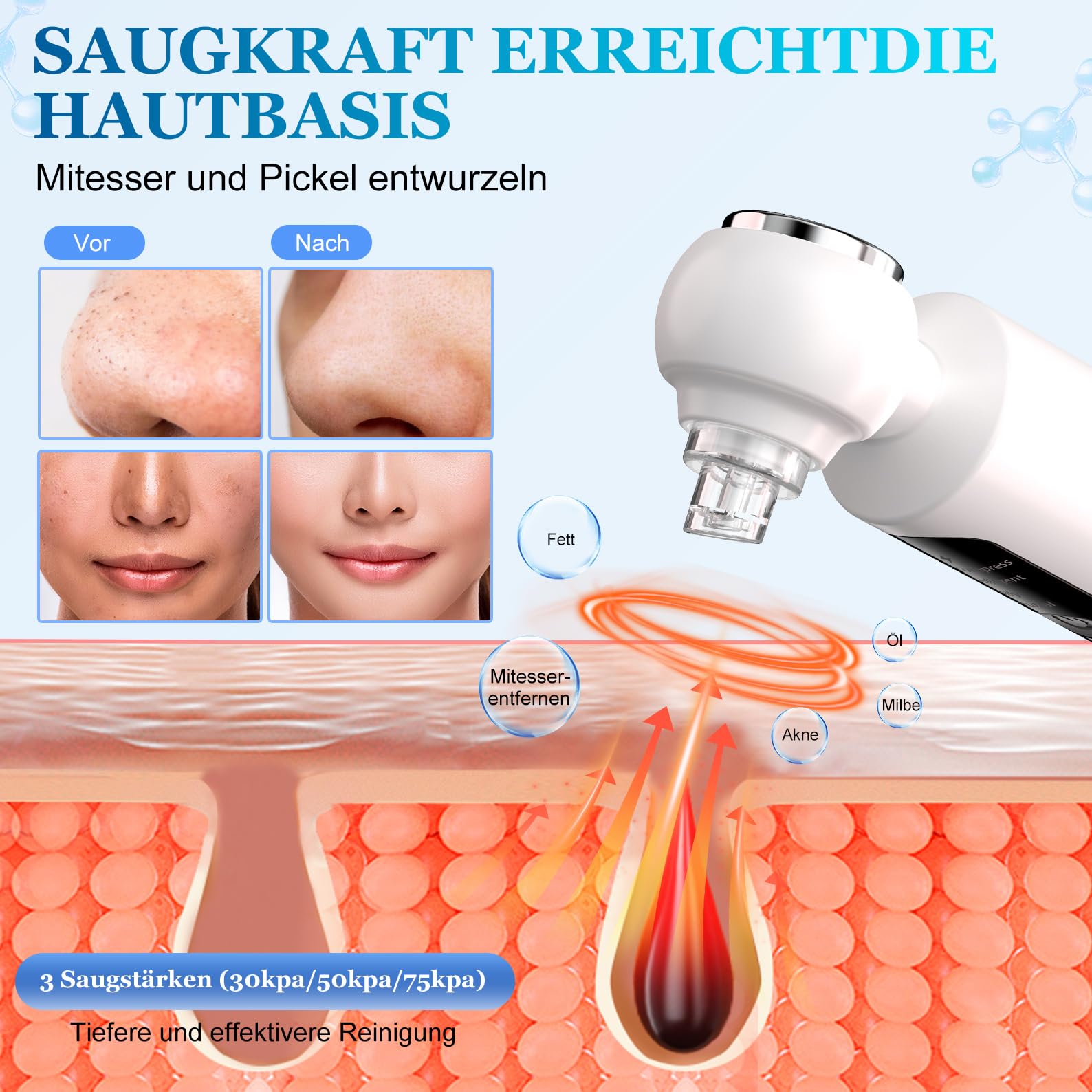 Limpiador de Espinillas y Poros para la Cara, 4 Modos, 6 Puntas de Succión y Depósito de Agua Visible, Diseño Patentado-Compresas Calientes, Limpieza Facial, Tratamiento del Acné, Limpiador de Puntos