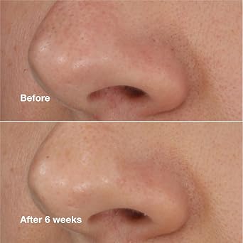 Clinique Blackhead Solutions Self-Heating Blackhead Remover With Salicylic Acid For All Skin Types, 0.68 Fl Oz