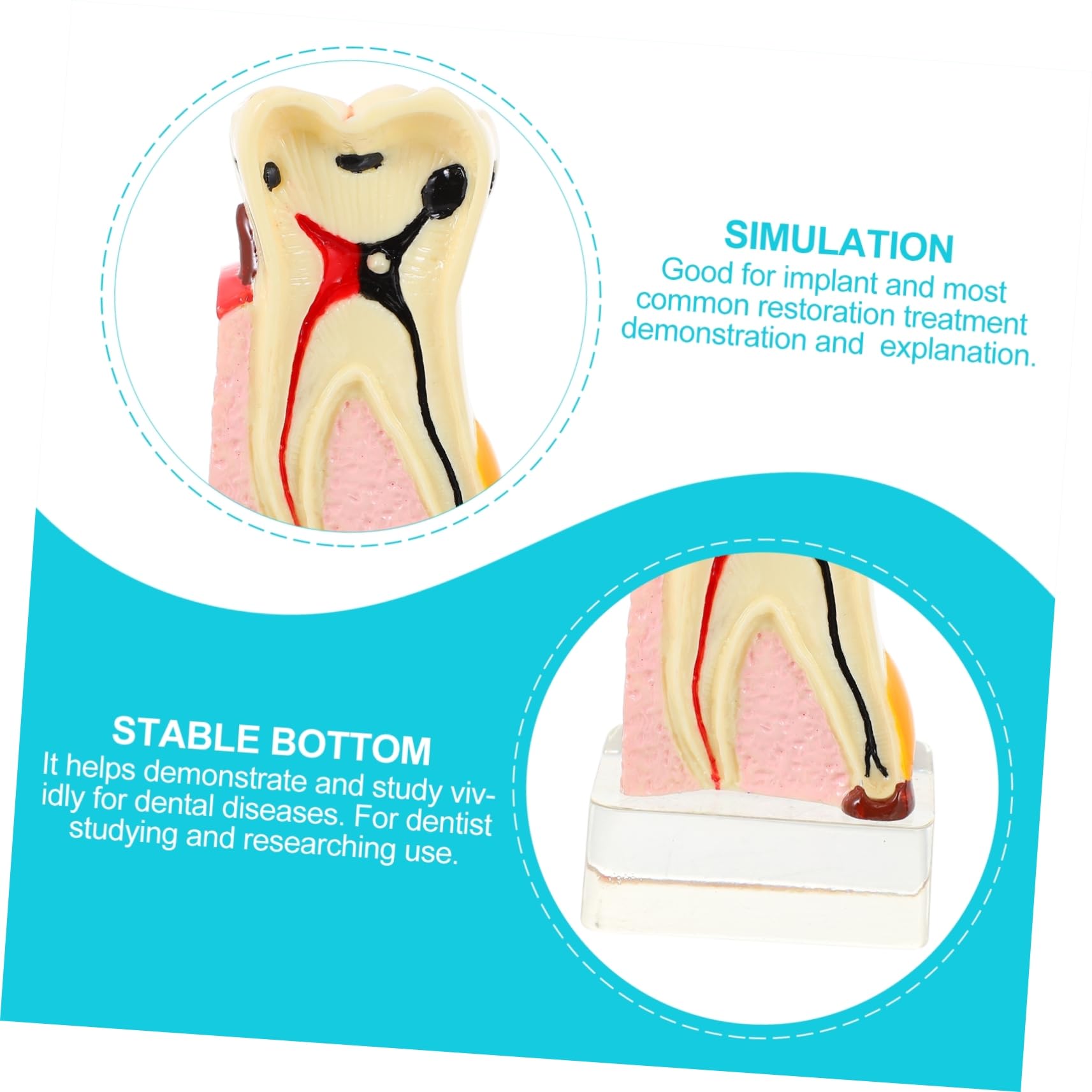 Modello di Carie Dentale in Resina Beige Leggero per Dimostrazione | Strumento Didattico Odontoiatrico, Modello Anatomico Denti per Studio, Materiale Resina
