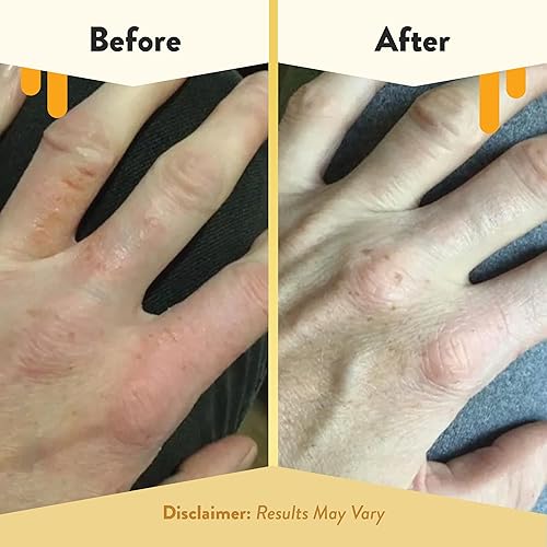 Miniatura 4 de ECZEMA HONEY Crema de manos de avena  Loción natural para manos y cuerpo para alivio de erupciones de eccema  Crema de eccema para piel seca, con