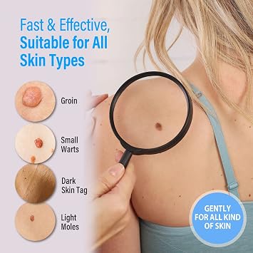 Skin Tag Removal Kit, Effective Wart Remover and Skin Tag Remover, 30ml
