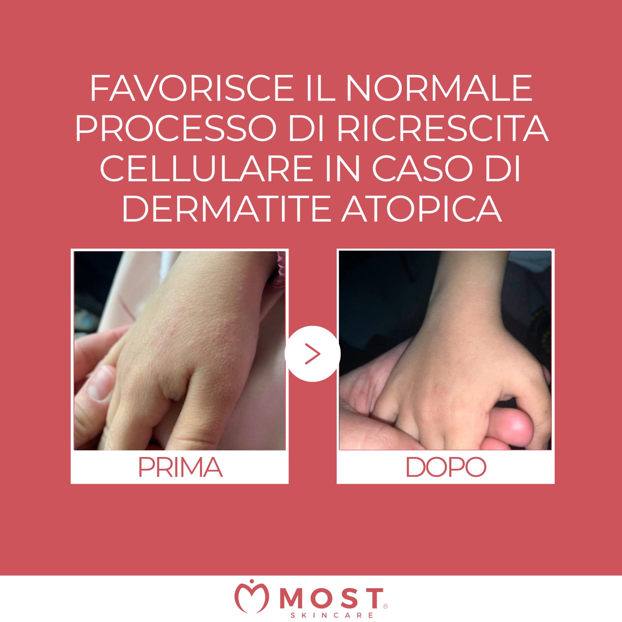 MOST - PEG Unguento Viso e Corpo Bambini e Adulti Lenitivo e Protettivo, Diminuisce Rossori e Stimola Processi di Riparazione Cutanea in Ragadi, Scottature Lievi, Cicatrici, Dermatite Atopica, 100 ml