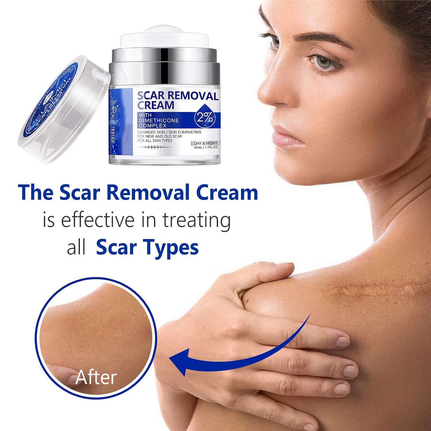 Scar Cream, Scar Removal Cream - Advanced Scar Cream for Surgical Scars, Acne Scars, C-Section, Burns, Stretch Marks -Effective for Old and New Scars Gel Acne Scar Treatment