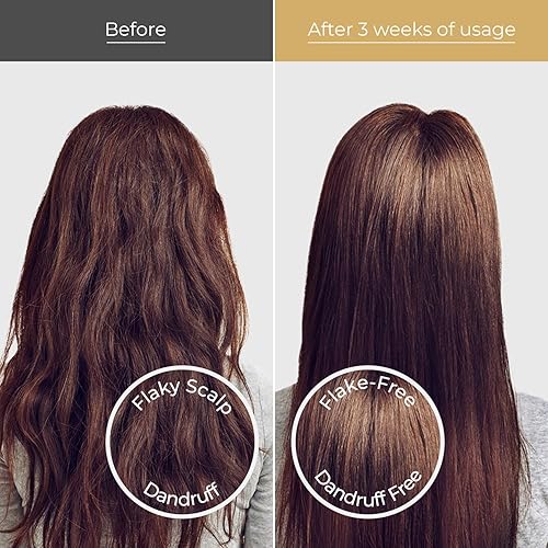 Miniatura 7 de Champú anticaspa, sin sulfatos, calmante para el cuero cabelludo seco, alivio de la picazón, aceite de árbol de té y vinagre de sidra de manzana,