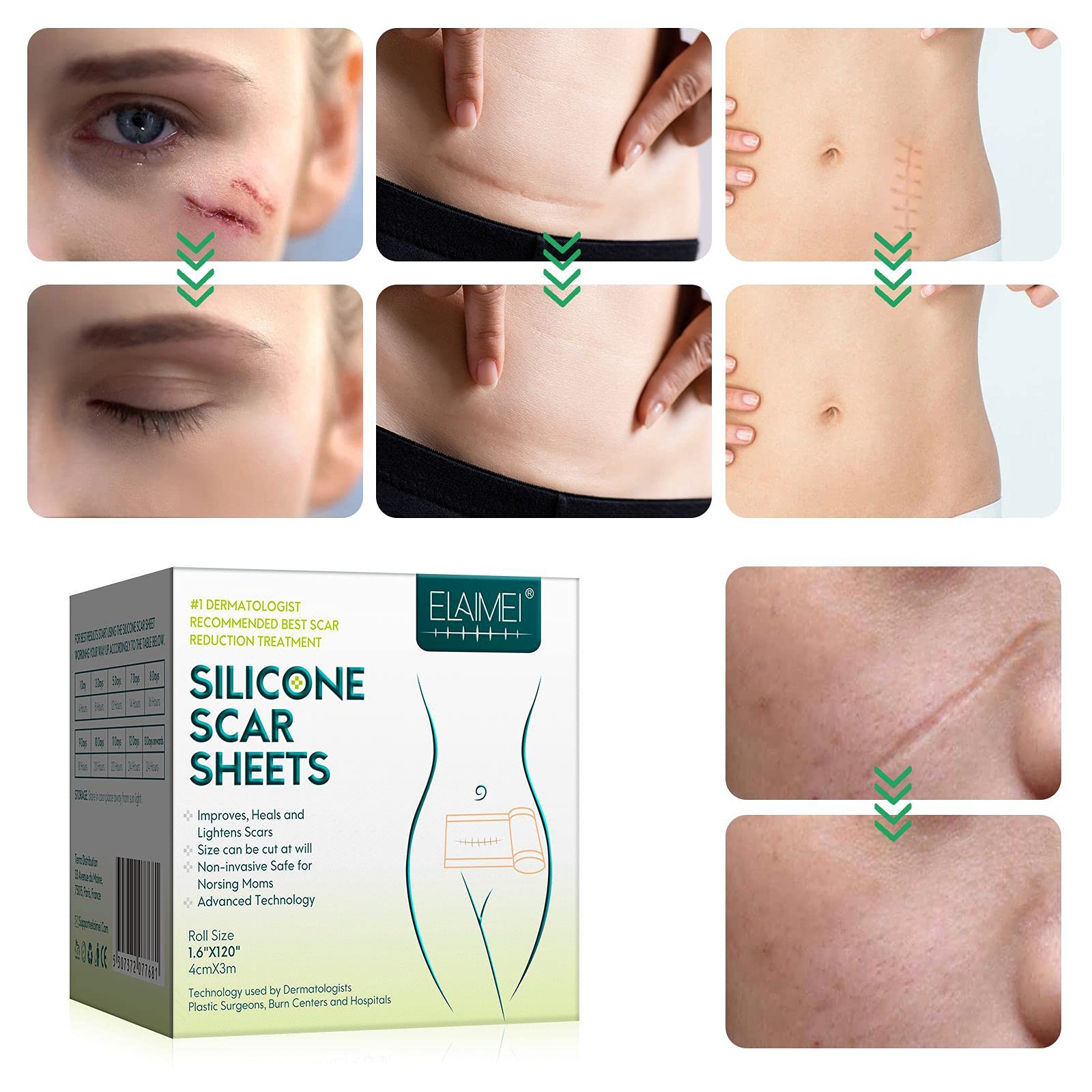 Feuille de cicatrice en silicone - (rouleau de 1,6 "x 120" - 3M) Rouleau de ruban cicatrice en silicone, Bande de silicone cicatrice,