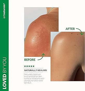 Amazon.com : artnaturals Aloe Vera Gel Set - JUMBO 20oz - Sunburn