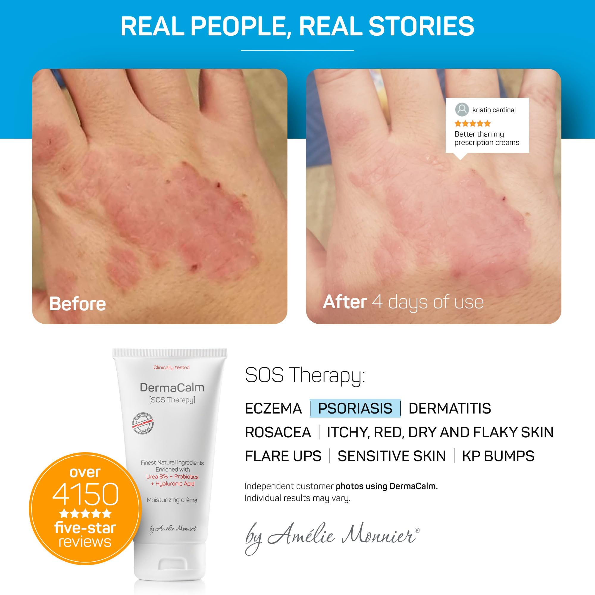 Clinically Tested DermaCalm SOS Therapy - Eczema Psoriasis Dermatitis Prone, Dry Skin - Urea 8%, Probiotics w/Best Natural Ingredients - Itchy, Severely Dry, Scaly Skin. Adults & Kids, Eczema Cream — Amazon image 3
