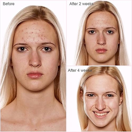 Miniatura 4 de NewWay 3 colores inalámbricos led facial luz T herapy para la piel de la cara rejuvenece la reducción de la arruga cuidado de la piel Anti-ging