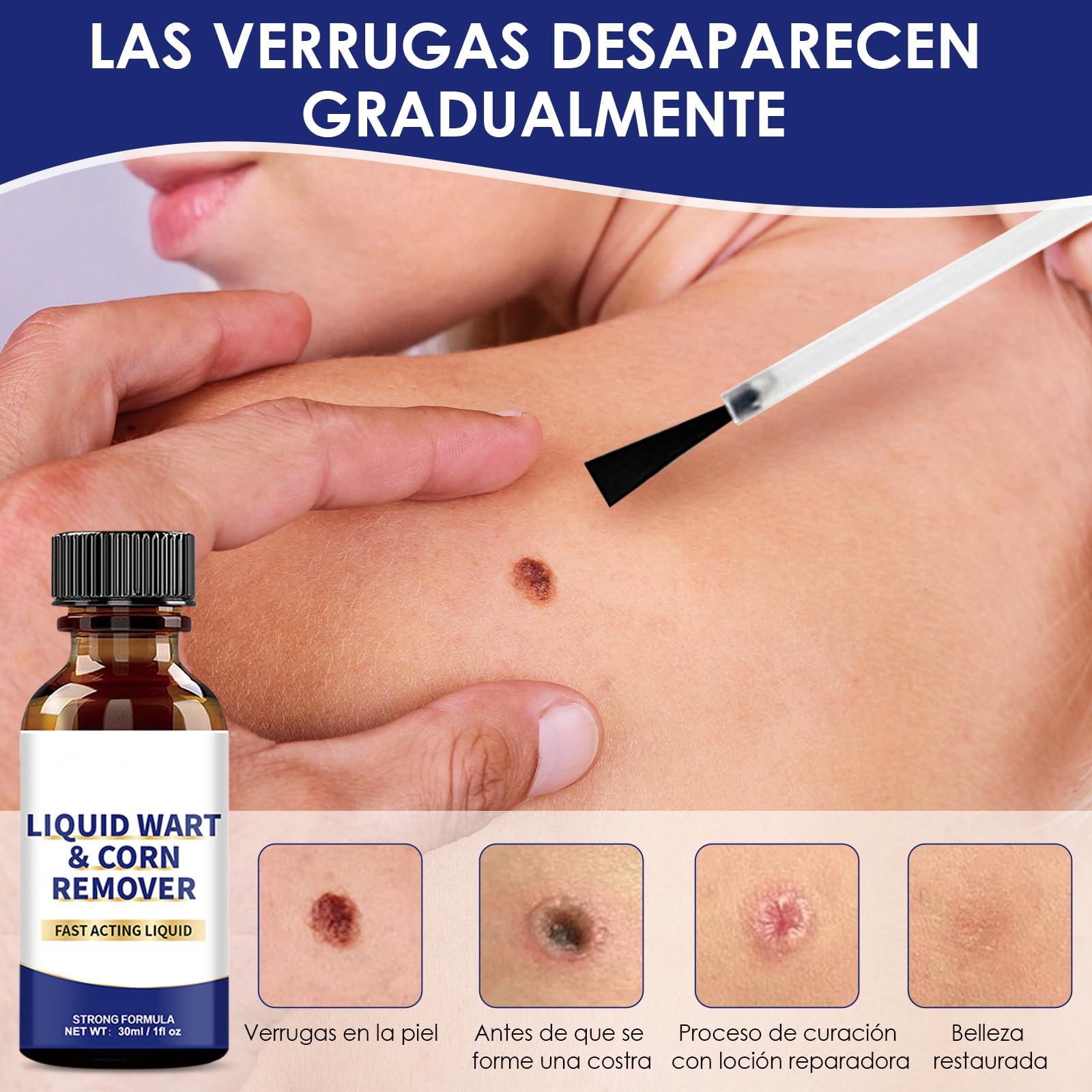 Quita Verrugas,Verrugas Quitar,Tratamiento Suave de Eliminar Verrugas,Pediculadas y Comunes1234567