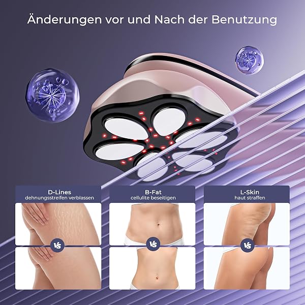 Cellulite Massager Anti Lipedema Hand Massager, Proven Effectiveness, with 6 Massage Heads, Suitable for Abdomen, Waist, Arms, Legs, Buttocks (Rose Gold) - 5