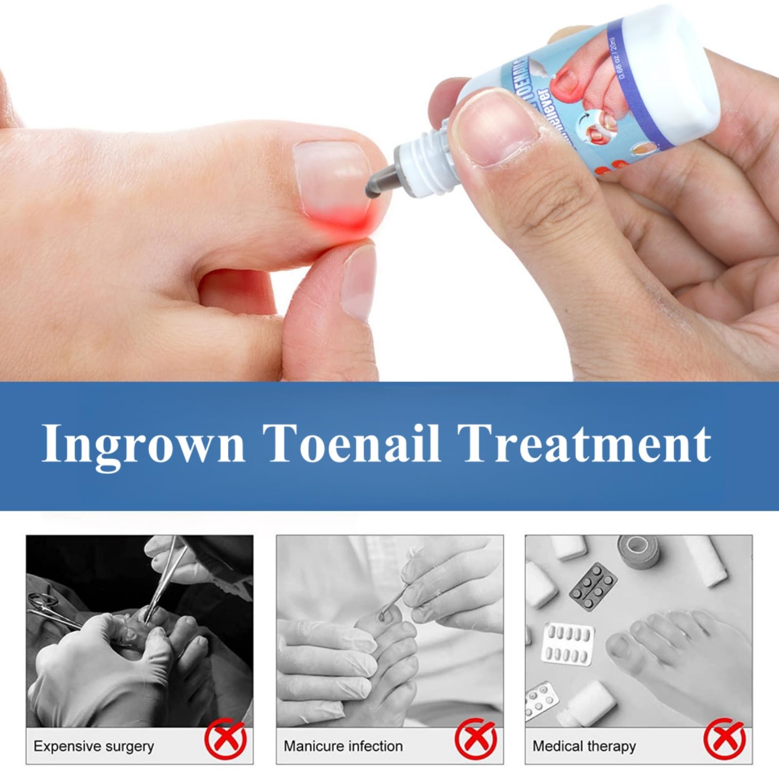 Ingrown Toenail Treatment, Ingrowing Toenail Treatment Extra-Strong, Ingrown Nail Treatments for Toenails 20ml - Image 4