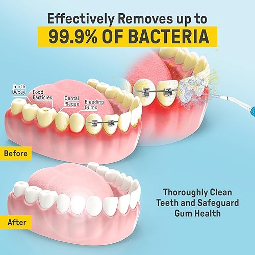 Miniatura 3 de Remi El mejor irrigador dental para un cuidado dental avanzado, salud superior de las encías y portabilidad sobre la marcha, perfecto para aparatos