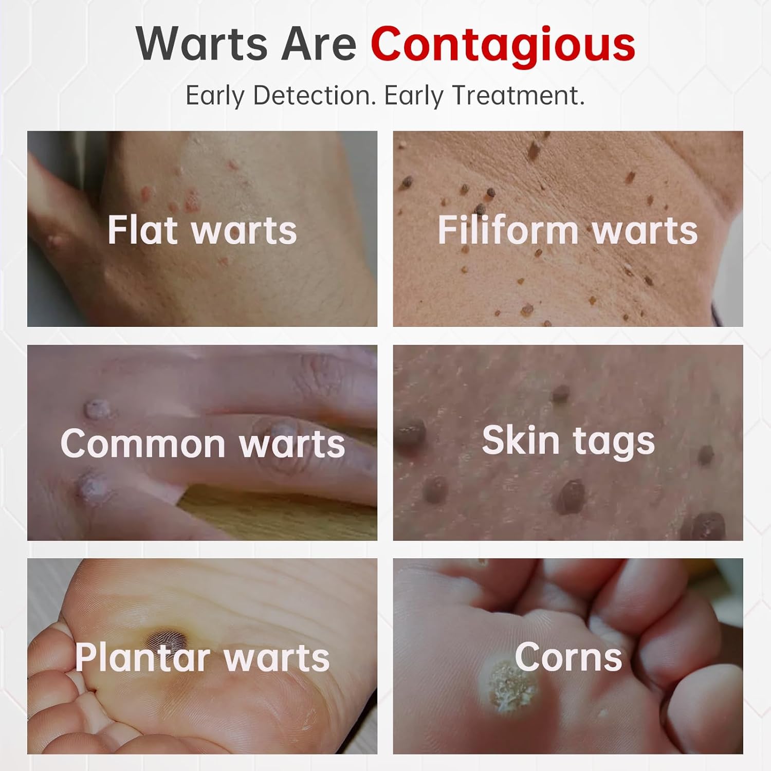 Wart Remover, 25% Salicylic Acid Wart Remover Liquid, Fast-Acting Treatment Wart Remover for Plantar Warts for Feet, Salicylic Acid for Warts, Corn Remover for Toes, Common & Flat Warts, 1.18FL.OZ