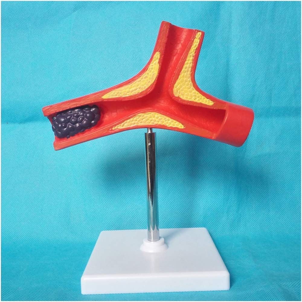 sjdoPulse Human Vascular Anatomical Model - Pathological Vascular Model - Medical Teaching Lesion Blood Vessel Anatomical Model - for Medical Educational Training Aid