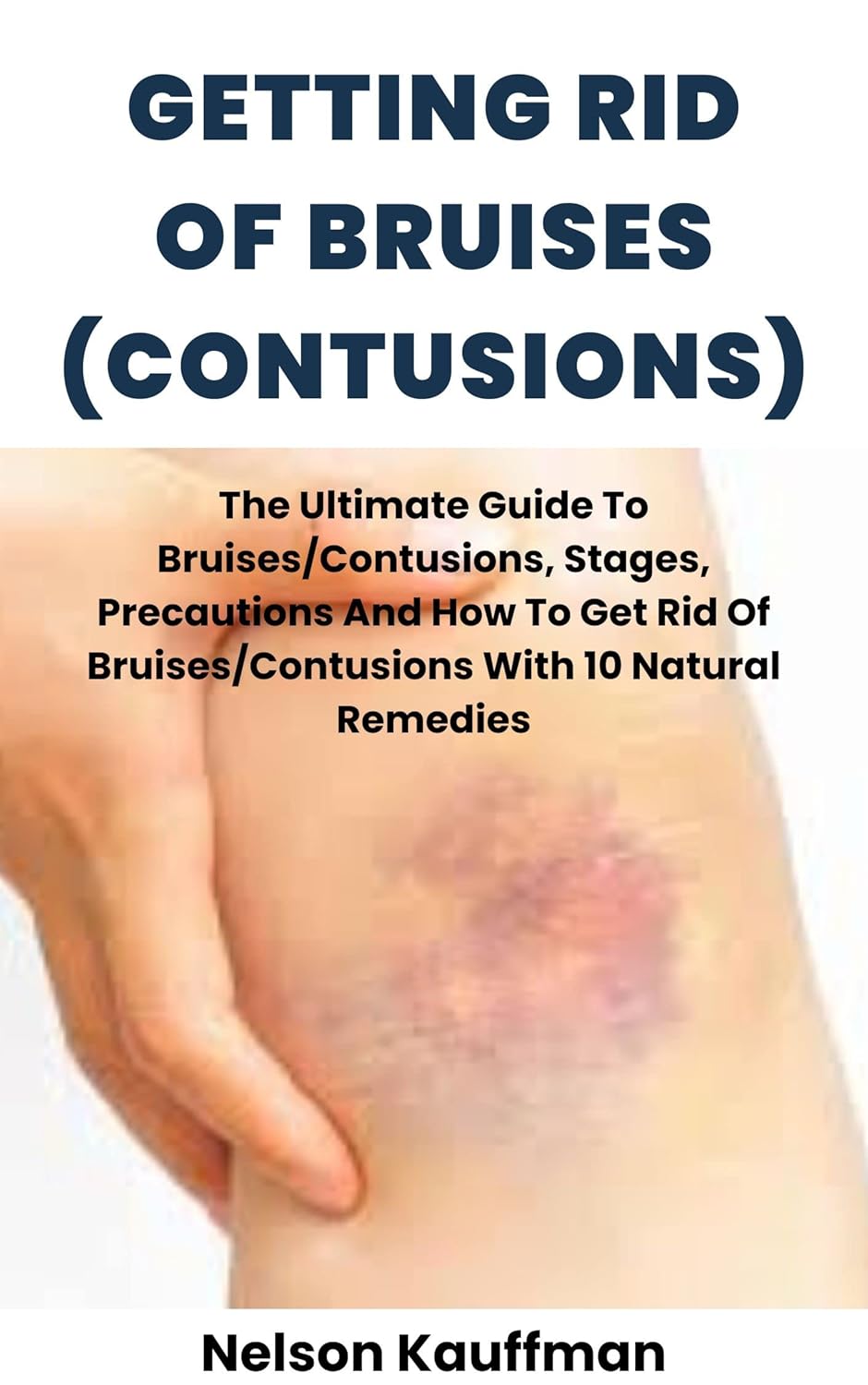 GETTING RID OF BRUISES (CONTUSIONS) The Ultimate Guide To Bruises