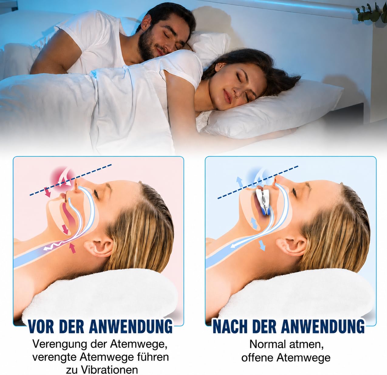 Schnarchstopper Anti Schnarch, Schnarchschiene– Ergonomisch, Effektiv Gegen Schnarchen, Anti-Snoring Mouth Guard, Verbessert Schlafqualität für Männer und Frauen (Weiß)