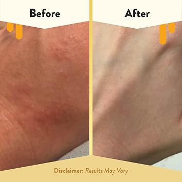 ECZEMA HONEY Oatmeal Body Lotion - Hand & Body Cream for Eczema Relief - Natural Dry Skin Repair (16 Oz)