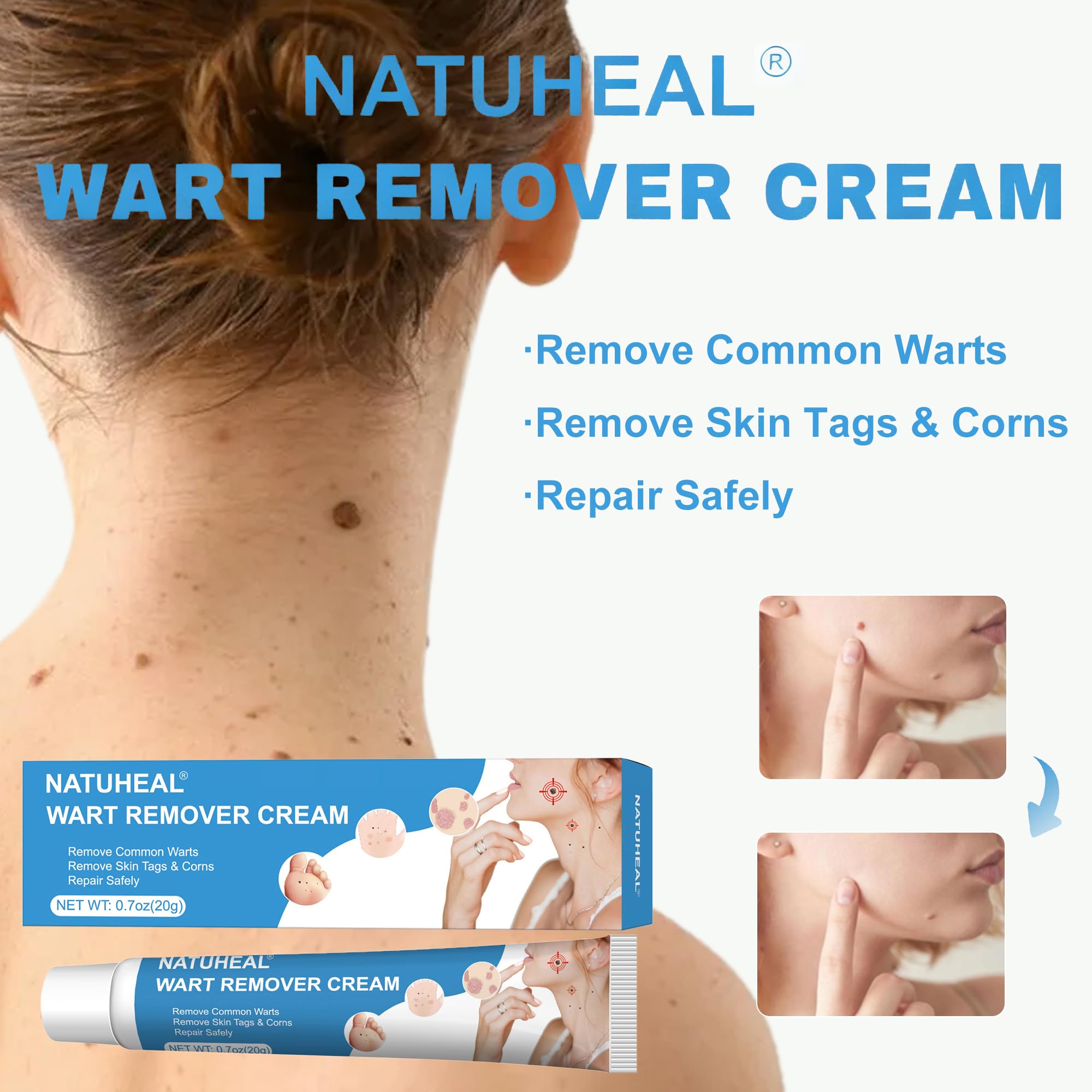 Wart Remover Cream 20g, Skin-Tag-Remover-Kit for Face & Body, Gentle Removal for Common Warts, Plantar warts, Corns — view 2