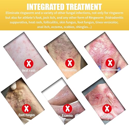 Miniatura 6 de 1 paquete de alivio de la picazón en los pies, la piel de la boca y la mano del pie, crema calmante, especial para picazón deportista, olor de pies,