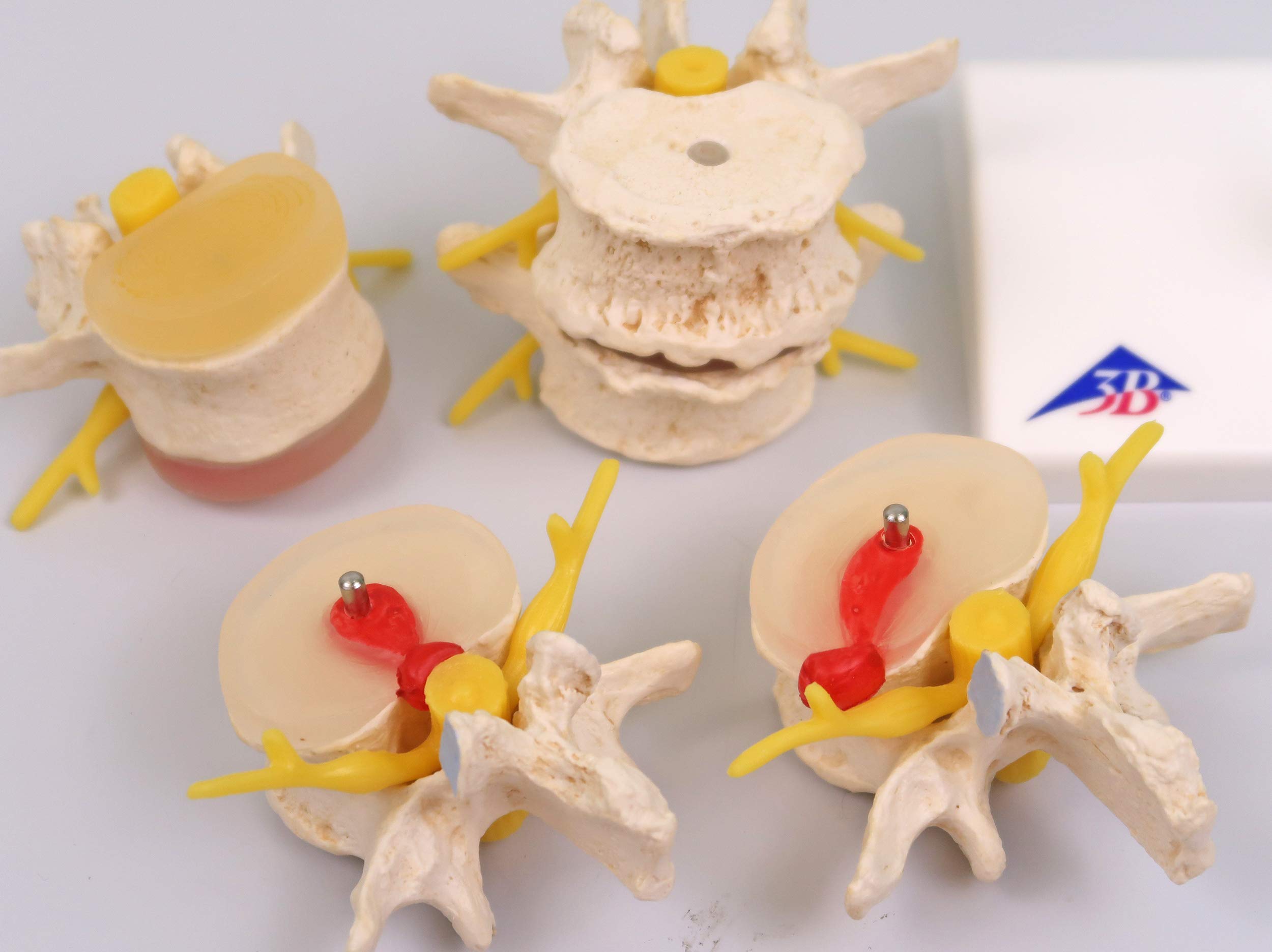 3B Scientific A795 Stadi dell'Ernia del Disco Intervertebrale e Degenerazione della Vertebra + software gratuito di anatomia - 3B Smart Anatomy