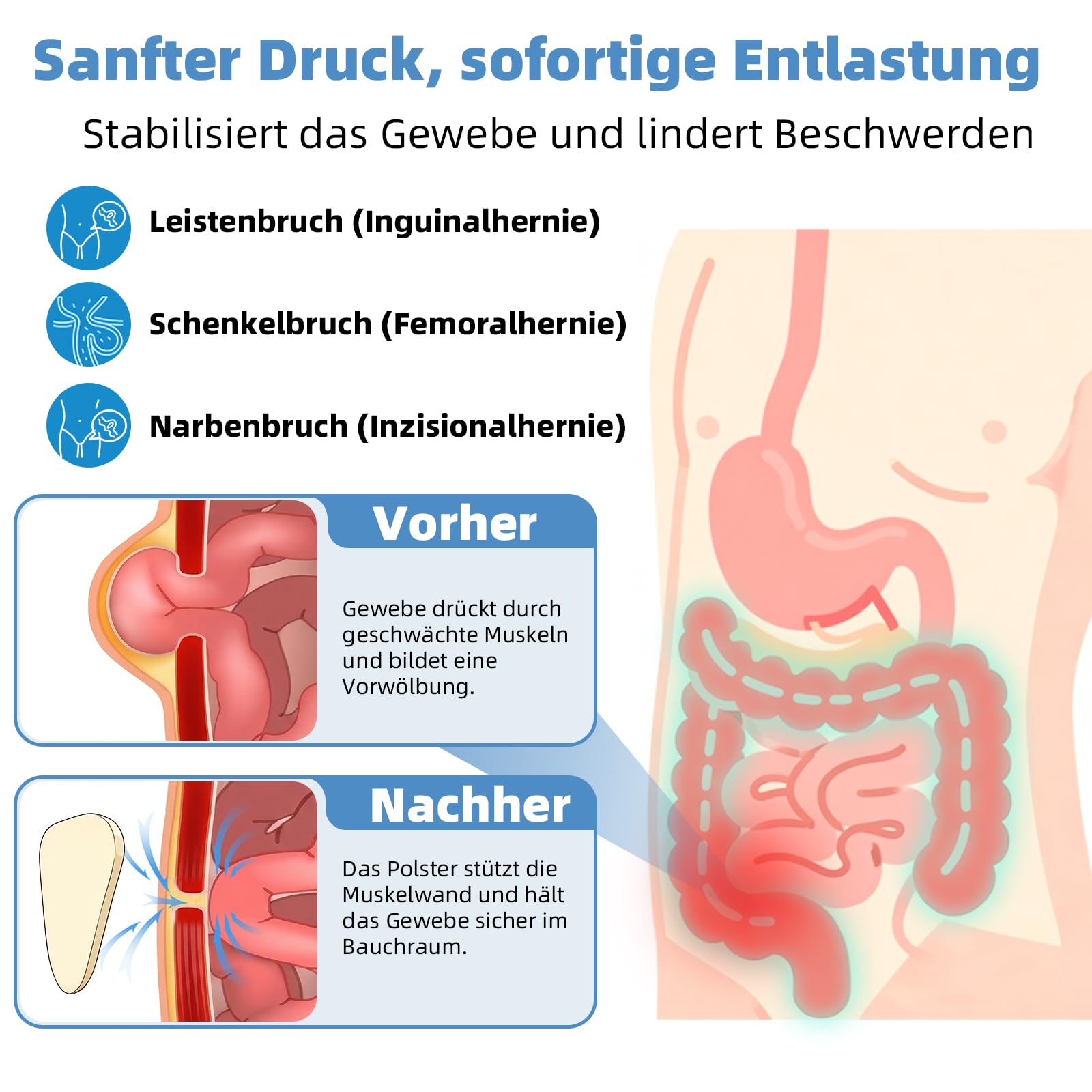 Tenbon Leistenbruchgürtel Für Männer Und Frauen Flexibel Einstellbarer Leistenbruch Gürtel Leistenbruch Stütz Schmerzlinderung mit 2 abnehmbaren Kompressionspolster Leistenbruch Links, Hernie (M)