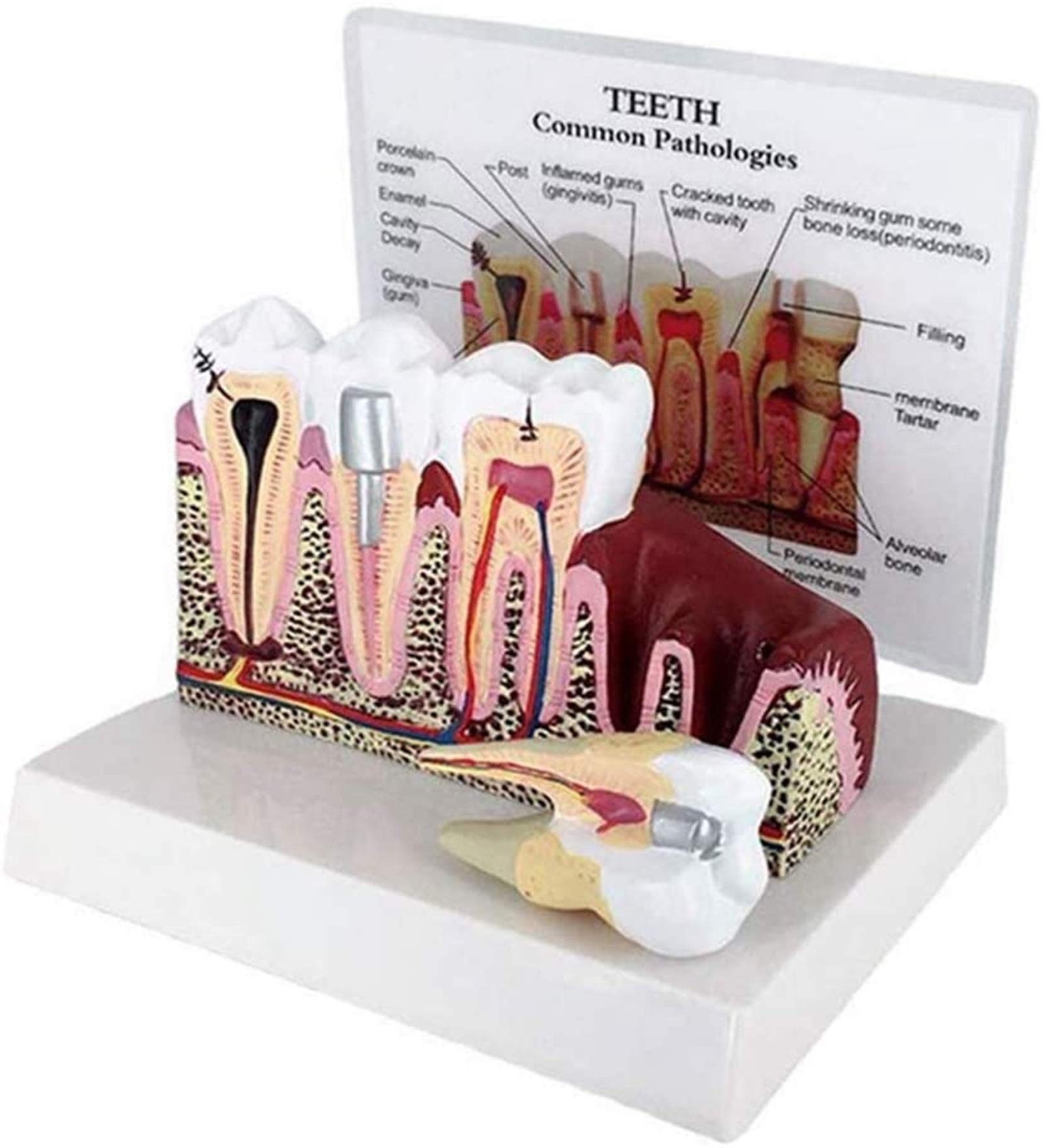 Buy Teeth CrossSection Model Gums Model Anatomy Teeth Model